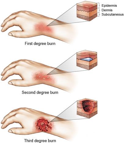 second degree burn third degree burn